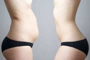 How Cavitation Removes Fat And Helps With Losing Weight And Inches?