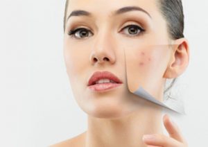 What Facial Treatment Is Best For Acne Scars